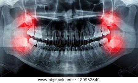 Photo of a film X-Ray scan human