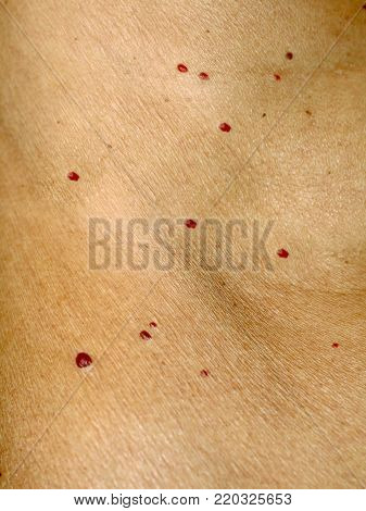 Angioma on the skin. Red moles on the body. Many birthmarks
