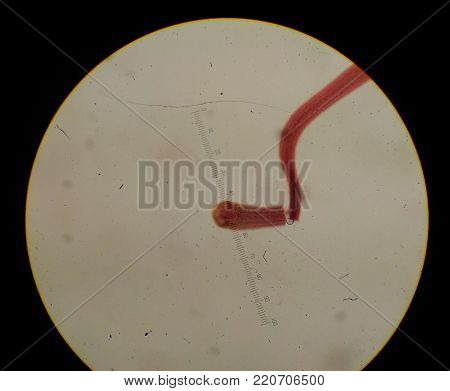 Acid Fast Bacilli Positive Red Cells.