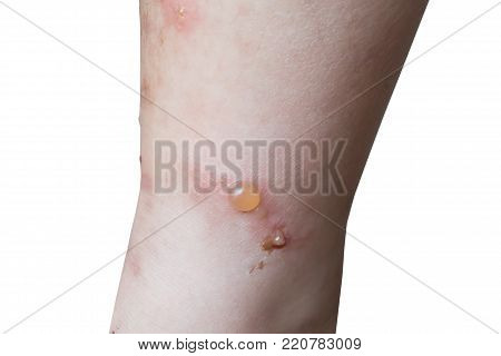 Leg of child with blister or burn wound isolate on white background.