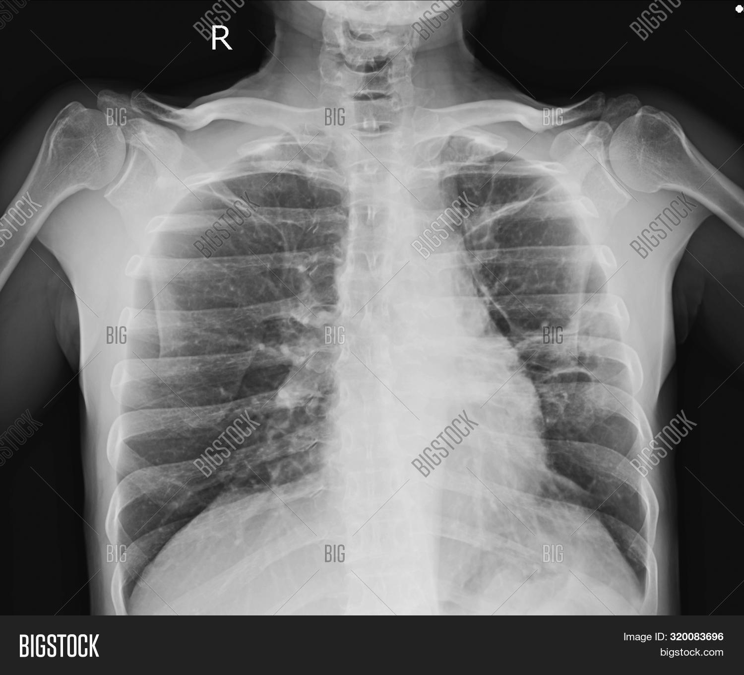 Pacemaker Xray Image Image & Photo (Free Trial) Bigstock