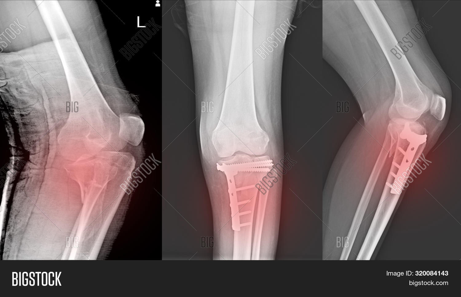 Xray Knee Joint Image & Photo (Free Trial) Bigstock