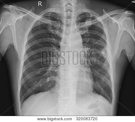 Pacemaker X-ray Image Image & Photo (Free Trial) | Bigstock