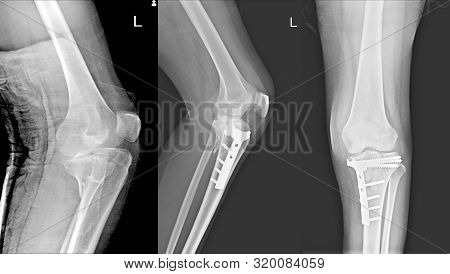 X-ray Knee Joint Fracture Proximal Tibia And Poat Fix Fracture Proximal Tibia With Plate And Screws.