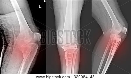 X-ray Knee Joint Fracture Proximal Tibia And Post Fix Fracture Proximal Tibia With Plate And Screws.