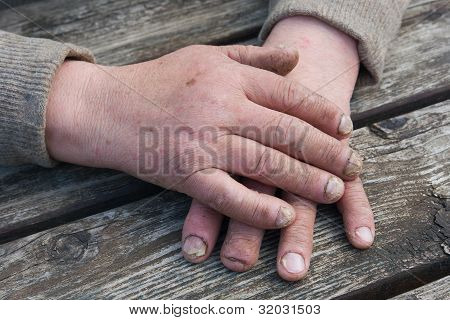 Fungal Nail infektion
