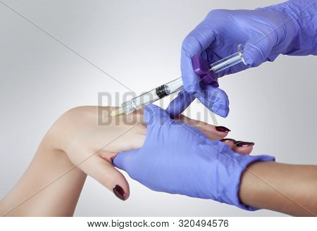 The Doctor Is Making Intramuscular Injections Of Botulinum Toxinon Hands Of A Woman.