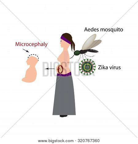 Zika Virus. Infection Of A Pregnant Woman. Mosquito Bite. Microcephaly In The Infant. Infographics. 