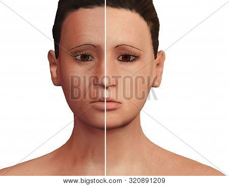 Before And After The Esthetic Process Of Rejuvenation After Prp Therapy. Facial Dermatological Treat