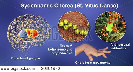 Sydenham's Chorea, An Autoimmune Disease That Results From Streptococcus Infection, Formation Of Ant