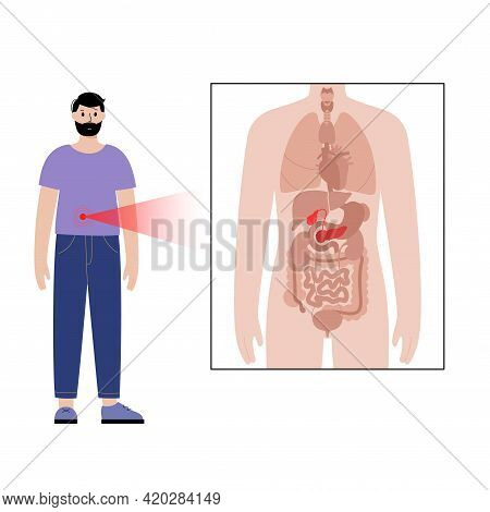 Pain Or Inflammation In Pancreas. Adult Man Anatomy Poster. Diabetes, Ache In Male Human Body. Inter