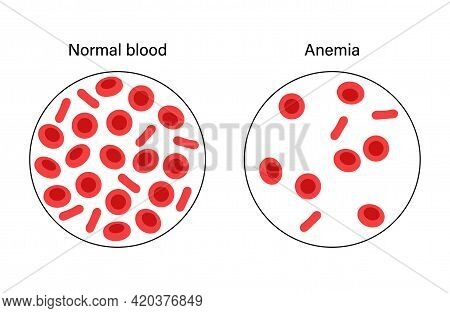 Normal Blood And Specimen With Anemia Disease. Human Blood Cells Structure. Thrombocytes, Leukocytes