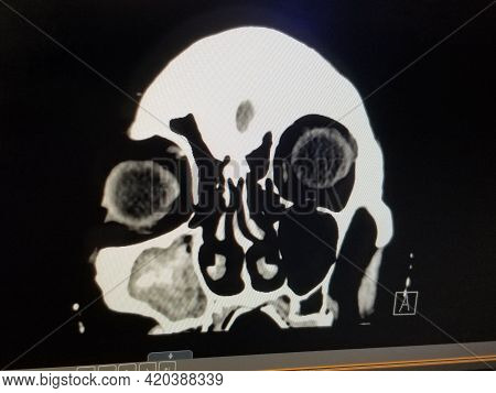 Coronal Ct Scan Of The Sinuses And Face - Right Maxillary Sinusitis