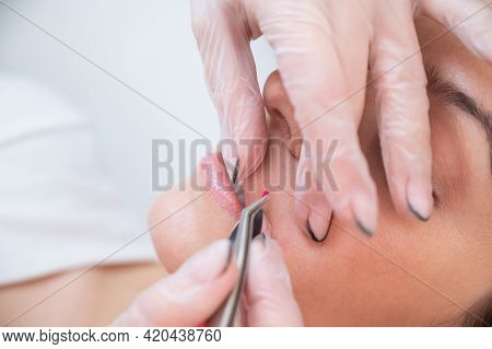 Woman On Electric Hair Removal Of Antennae. Hardware Permanent Removal Of Unwanted Facial Hair.