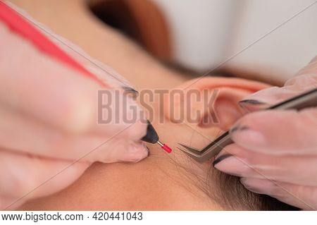 Woman On Electro-epilation Of The Face. Hardware Permanent Removal Of Unwanted Hair In The Salon