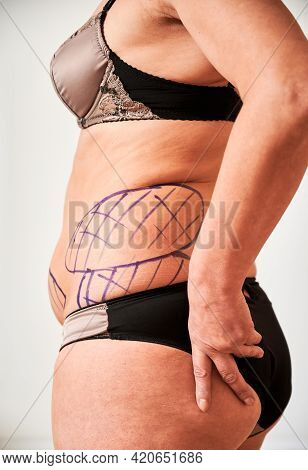 Close Up Side View Of Female Patient Belly With Blue Marks For Aesthetic Surgery. Fat Woman In Under