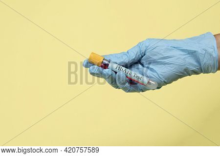 Blood Sample In A Vacuum Tube For Hemoglobin Hba1c Test  Diabetes Diagnosis