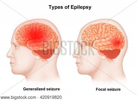 Medical Illustration Of Human Brain Types Of Epilepsy