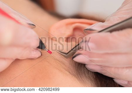 Woman On Electro-epilation Of The Face. Hardware Permanent Removal Of Unwanted Hair In The Salon