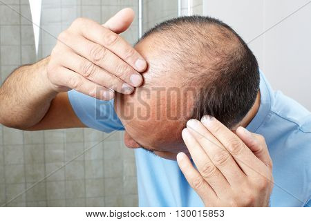 Hair loss.