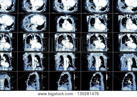 CT scan of the patient. Medical background.