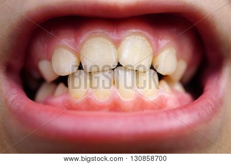 caries on the teeth of the child close up.