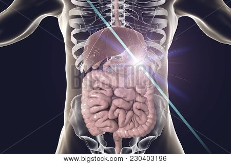 Stomach Cancer Treatment And Prevention Concept, 3d Illustration