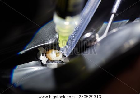 Closeup Of A Dental Injection Performed By A Doctor