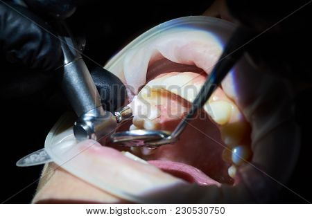 Close-up Of Polishing Teeth. Dental Services In Modern Clinic. The Concept Of Modern Stomatology