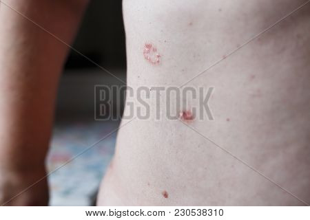 Psoriasis Skin. Psoriasis Is An Autoimmune Disease That Affects The Skin Cause Skin Inflammation Red