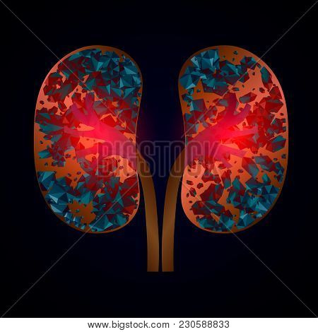 Nephrolithiasis Kidney Stones Disease. Vector Medical Illustration Isolated. 10 Eps