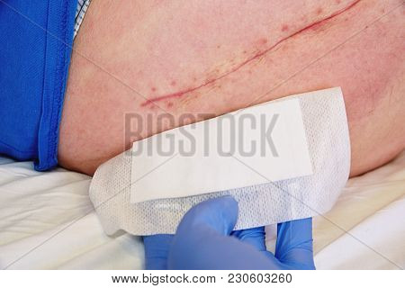 Wound On The Skin. Body With Collarbone Injury. The Operating Seam Is Visible. The Gauze Swab Is Rem