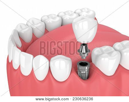3D Render Of Jaw With Teeth And Dental Premolar Implant