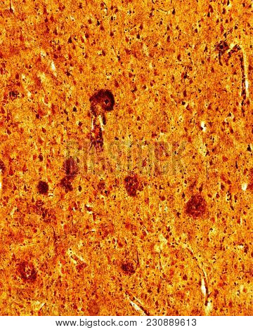 Light Microscope Micrograph Of A Senile Cerebrum, Stained With A Silver Method. The Round Dense Stru