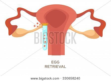Egg Retrieval Stage In Vitro Fertilization Artificial Insemination