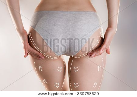 Medicine, Cosmetology And Cellulite. A Young Woman Of Athletic Build Wraps Her Hands Around Her Butt