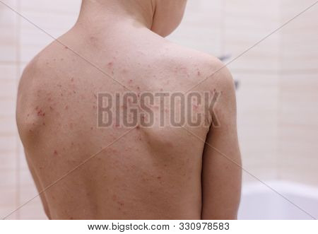 Childs Back. Eczema Image & Photo (Free Trial) | Bigstock