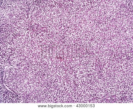 인간의 간 지방 Hepatosis