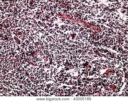 인간의 작은 세포 폐 암