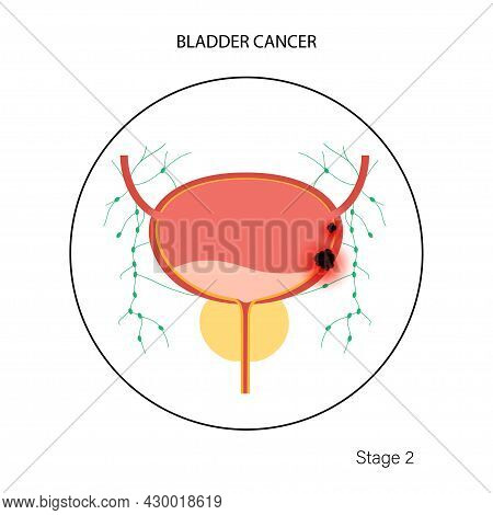 Bladder Cancer, Second Stage Of Tumor Spreading. Bladder, Urethra, Lymph Nodes, Prostate In Male Bod