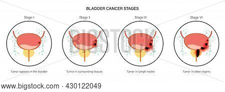 Bladder Cancer Stages Anatomical Poster. Bladder, Urethra, Lymph Nodes And Prostate In Male Body. In