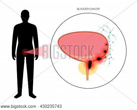Bladder Cancer Stages Anatomical Poster. Bladder, Urethra, Lymph Nodes And Prostate In Male Body. In