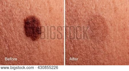 Photo Before And After Removal Of Large Mole On Woman's Skin. Mole Removal Concept