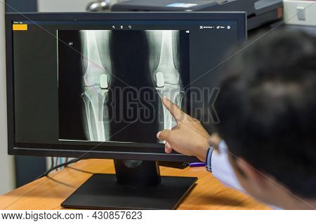 Doctor Pointing On The Knee Problem Point On X-ray Film. X-ray Film Show Skeleton Knee On Film. Surg