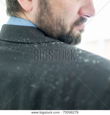Business man having man dandruff in the hair