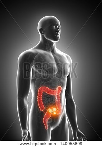 3d rendered medically accurate illustration of colorectal tumor