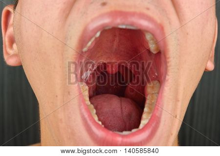 Detailed Image Of Young Man With The Mouth Opened. Details Of The Inner Mouth, Masses, Teeth, Tonsil