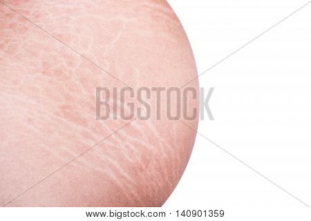 Macro Stretch Marks Of Skin On The Belly Isolated On White