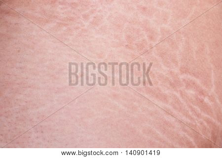 Stretch Marks Of Skin On The Thigh