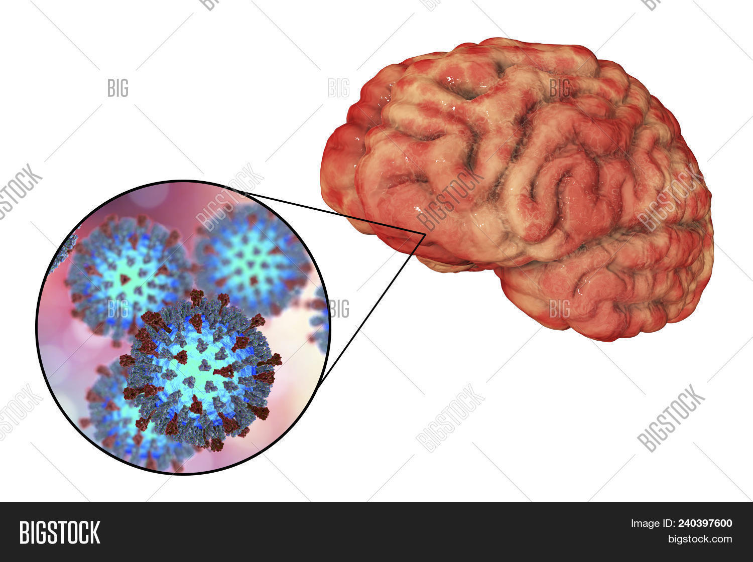 цифолит. последствия клещевого энцефалита. менингоэнцефалитическая форма клещевого энцефалита. корь энцефалит. корь энцефалит.
